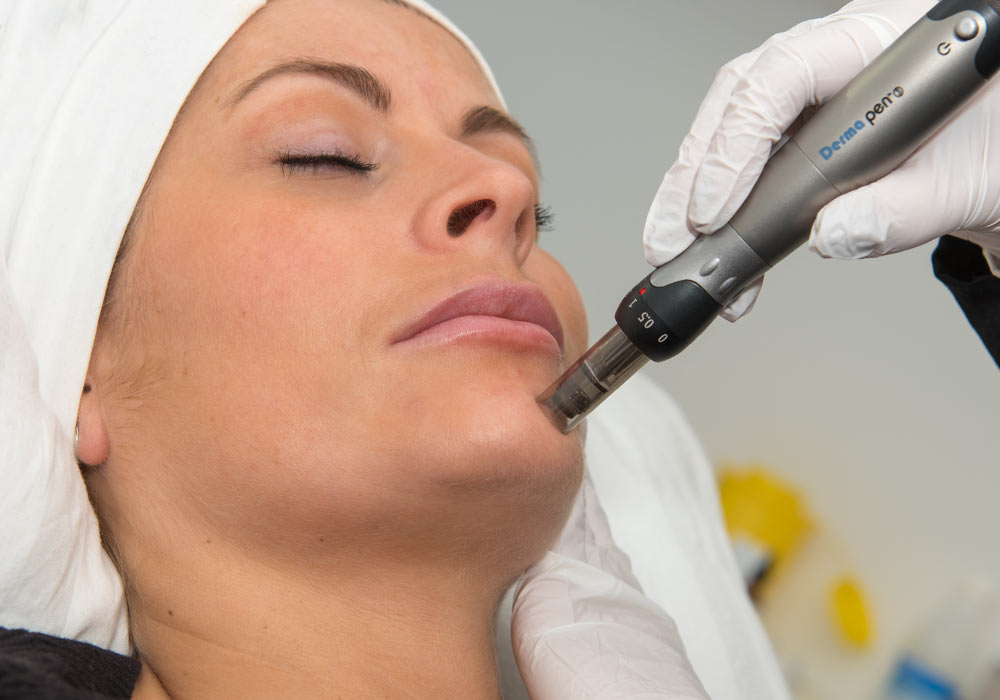 Dermapen (micro needling) Dermapen (micro needling)