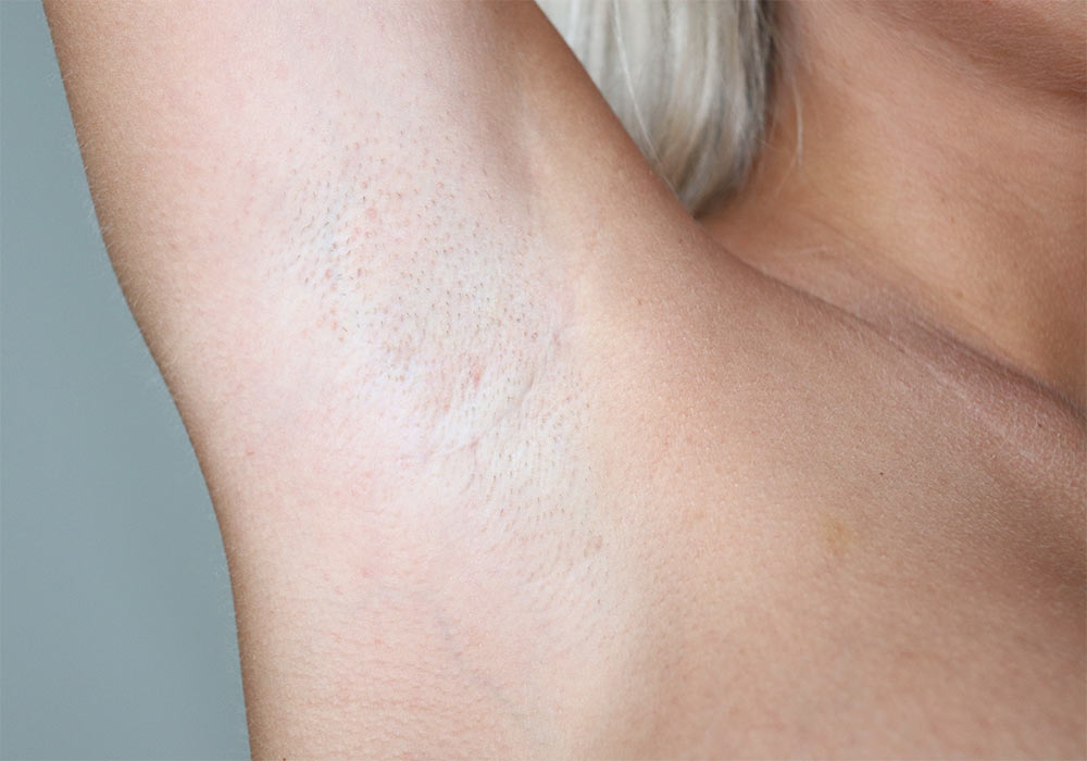 Brystforstorrelse via armhulen (transaxillær brystforstørrelse)