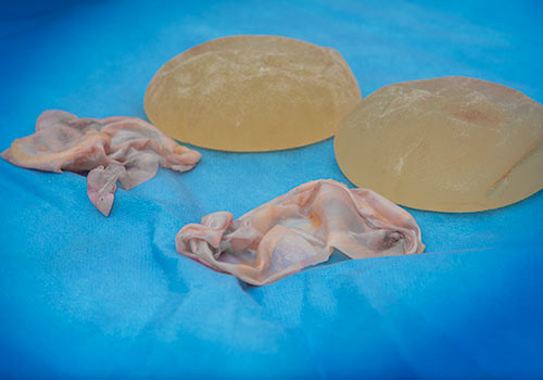 En bloc kapselektomi