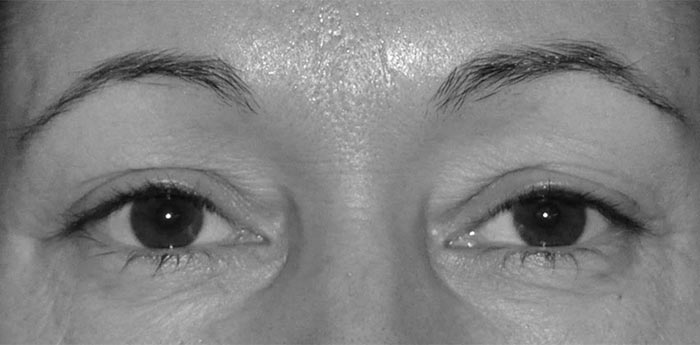 Øyelokk-pasient Øyelokk-pasient