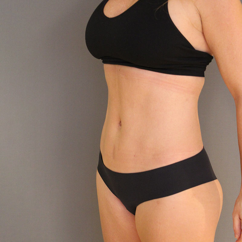 Bukplastikk-pasient etter operasjon