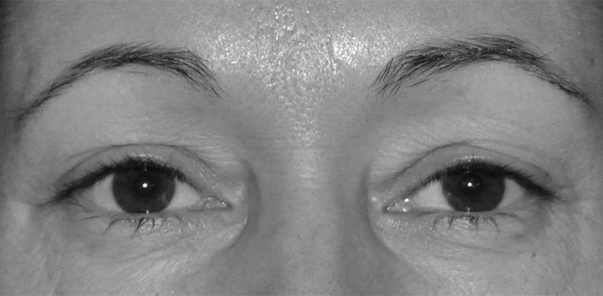 Pasient som egner seg for øyelokksoperasjon Øyelokksoperasjon