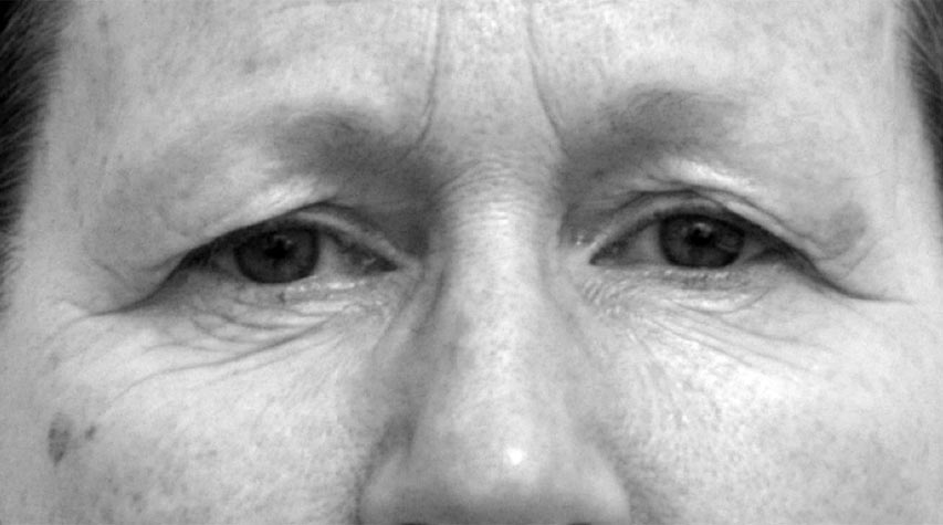 Panneløft-pasient panneløft-pasient