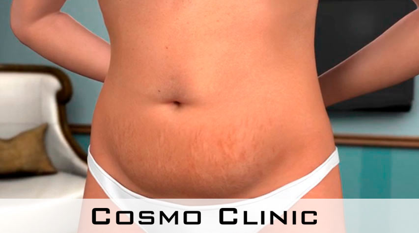 Delte magemuskler (rektusdiastase) Delte magemuskler (rektusdiastase)