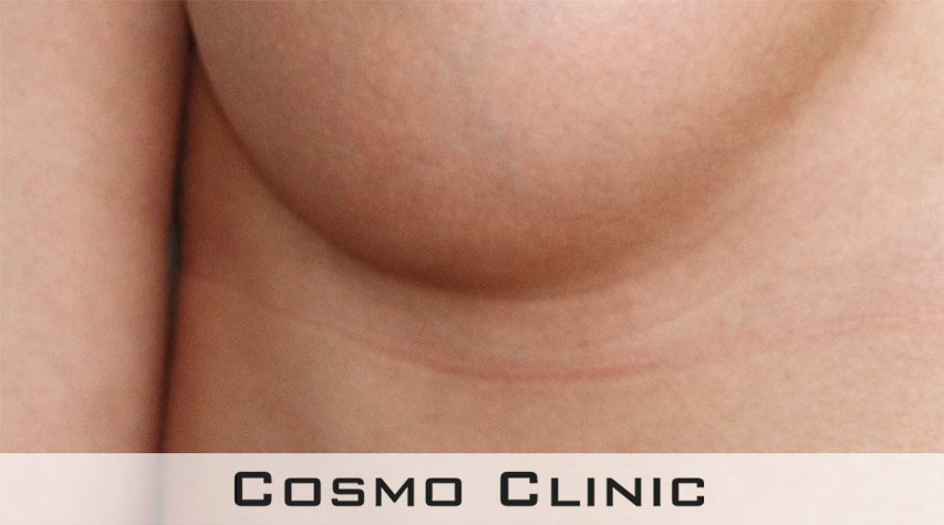 bryst etter operasjon