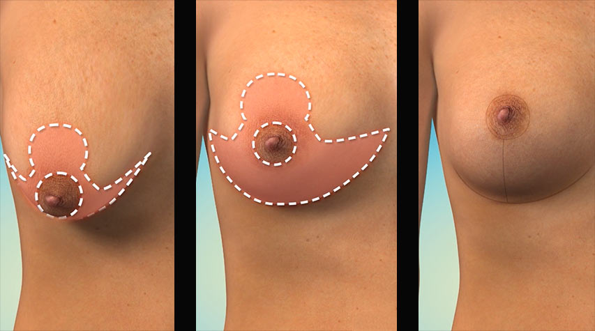 arr etter brystløft