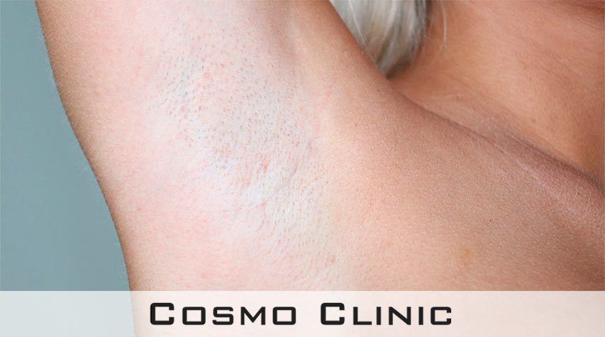 Transaxillær brystforstørrelse