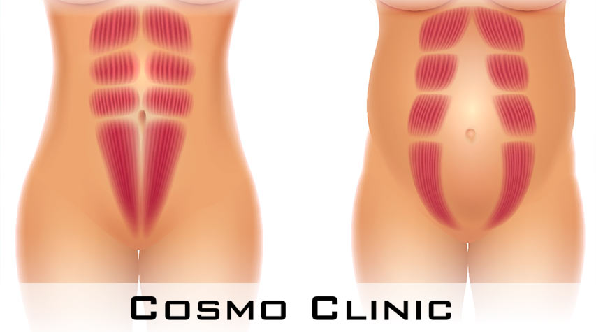 delte magemuskler (rektusdiastase)