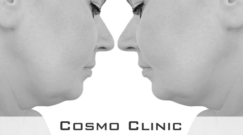 dobbelthake erfaringer etter operasjon fettsuging