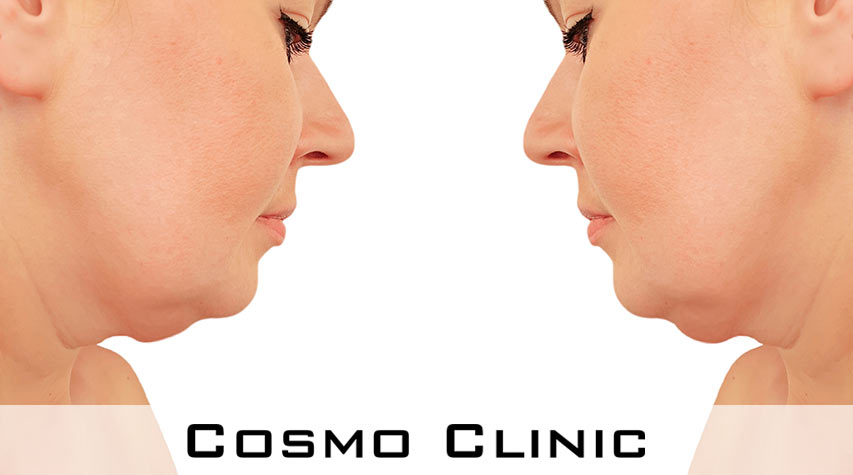 fettsuging av haken ved dobbelthake