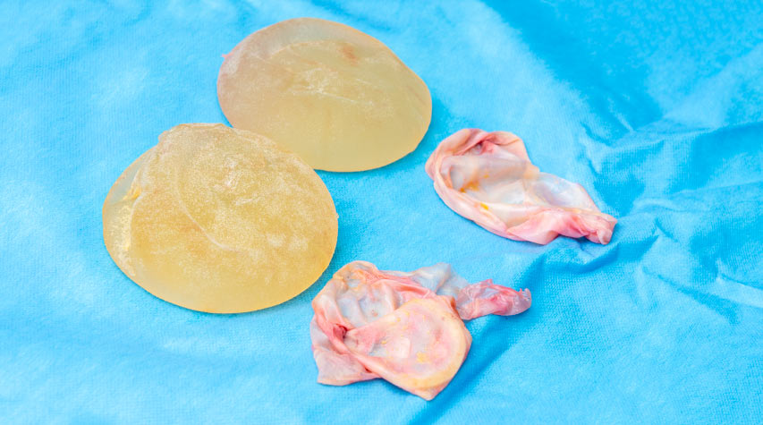 fjerne silikon med kapsel