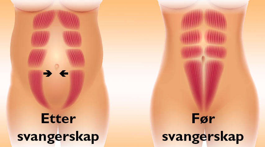 Før og etter svangerskap med skilte magemuskler
