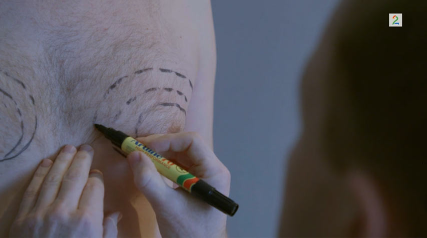 Innslag om gynekomasti på TV2 Helsekontrollen
