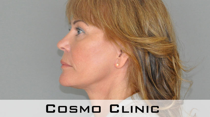 halsløft (Cosmo Neck)