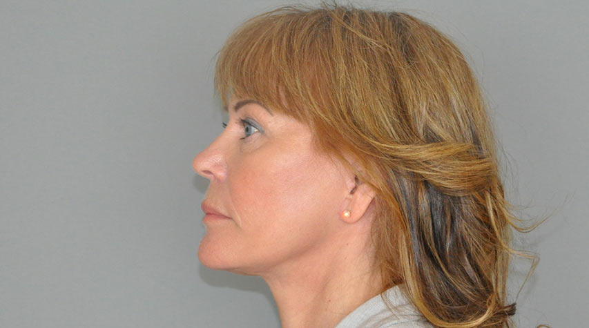 Pasient dobbelthake halsløft