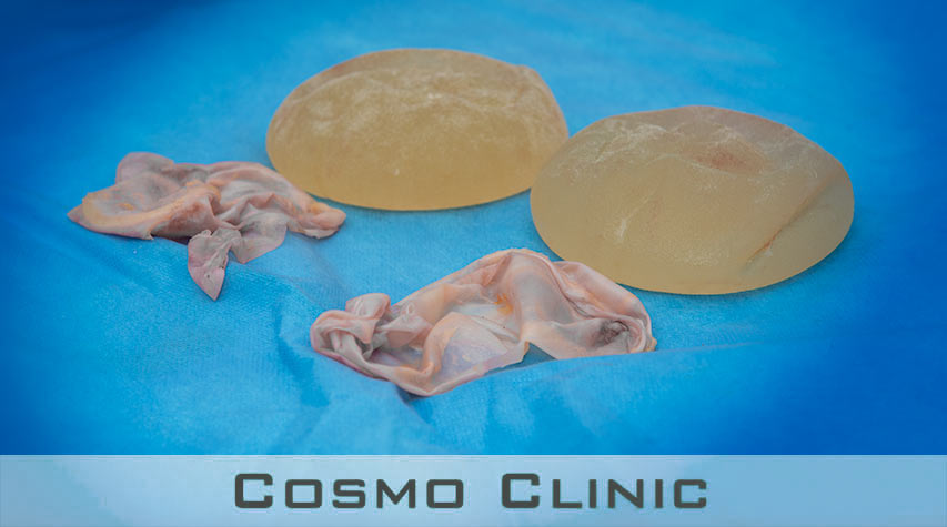 Hard kapsel og silikon operasjon enblock