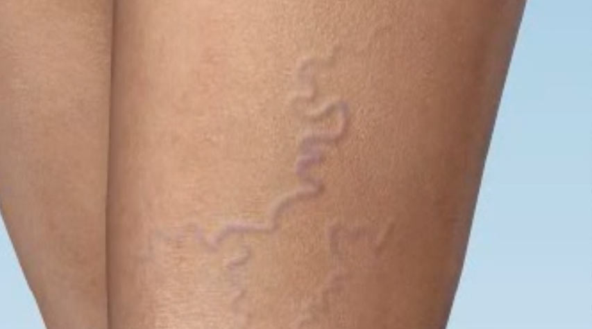 Åreknuter på lårene