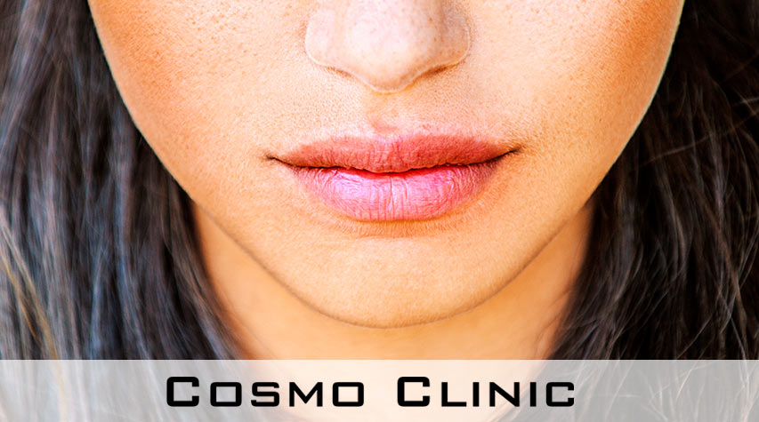 Leppebehandling Leppebehandling for større lepper