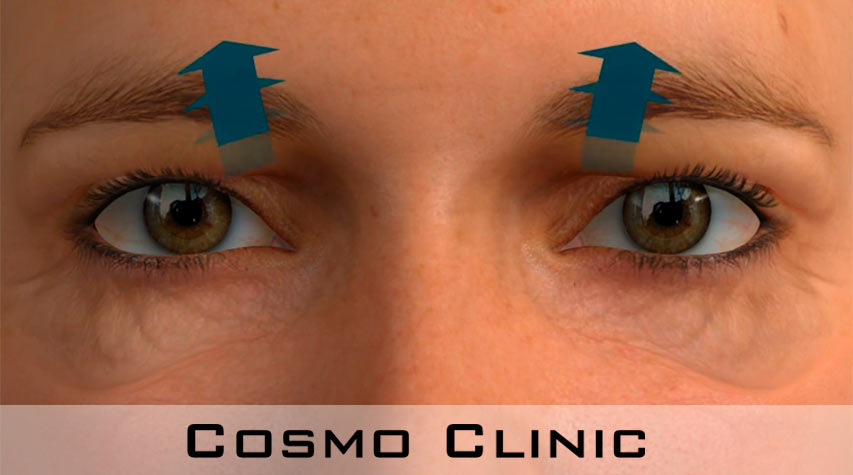 Øyelokkoperasjoner av tunge øyelokk