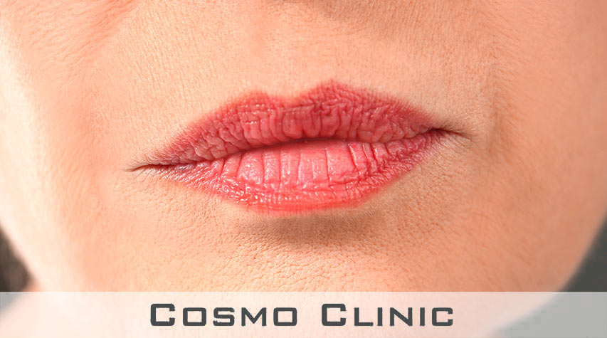 Røykemunn rynker overleppen