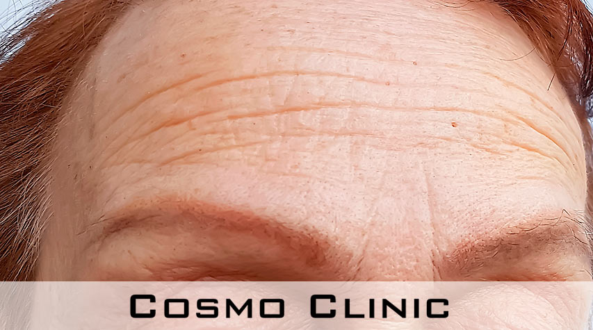 Rynker i pannen Rynker i pannen