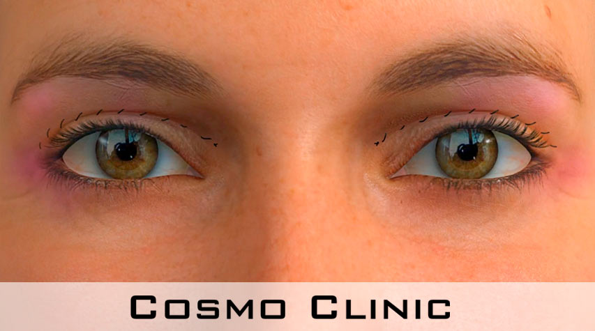 Ved øyelokksplastikk kommer arrene i globallinjen