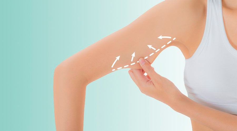 Armplastikk armplastikk ved grevinneheng o.l.