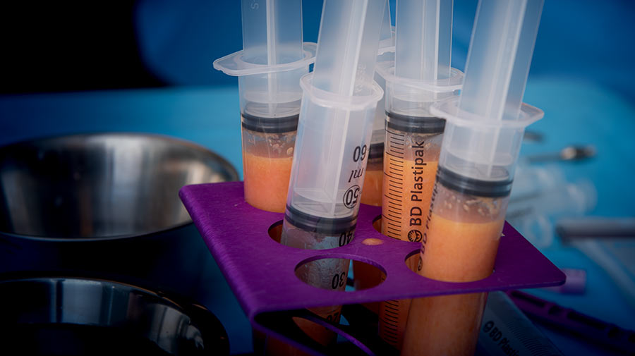 900x505 yt fettransplantasjon 20190814 cosmo 0219