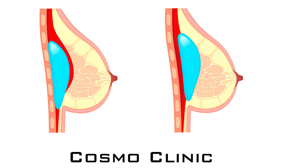 En bloc kapselektomi (fjerning av protesen og hele kapselen)