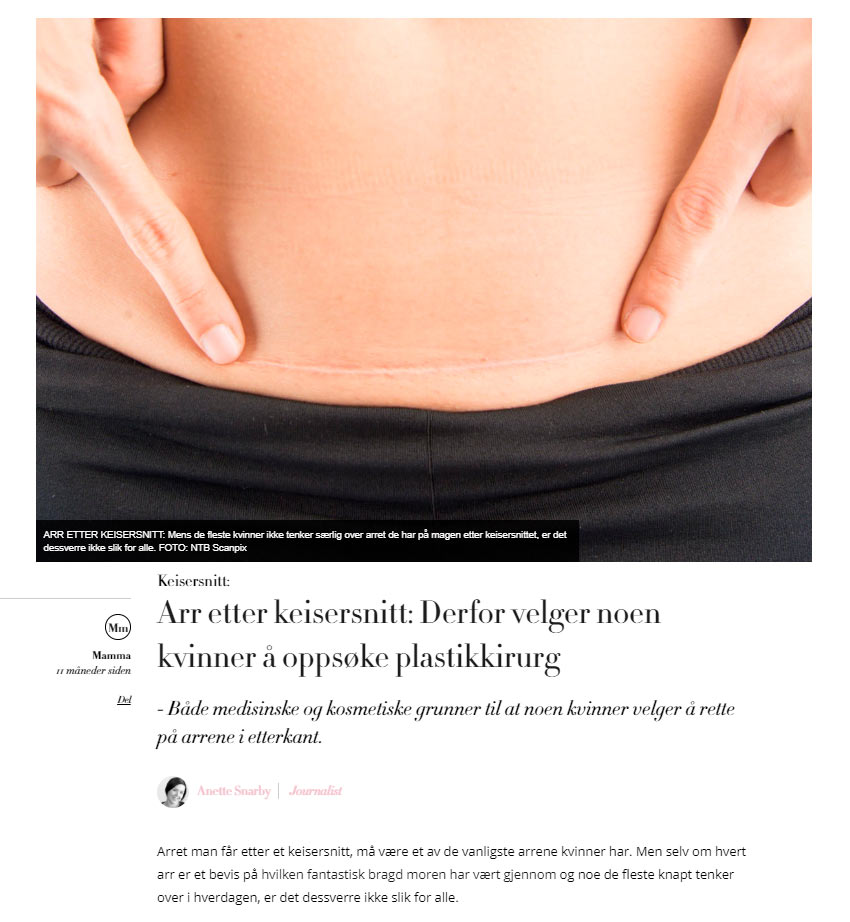 Arr keisersnitt Arr keisersnitt